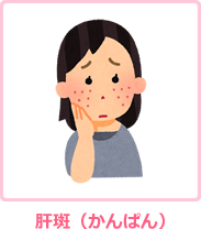 肝斑(かんぱん)